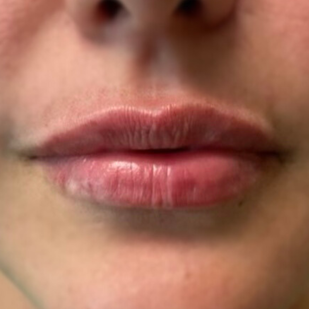 Lip Filler After