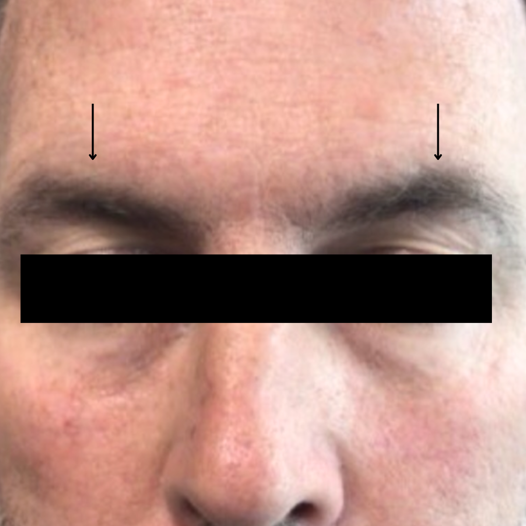 After PRP Microneedling