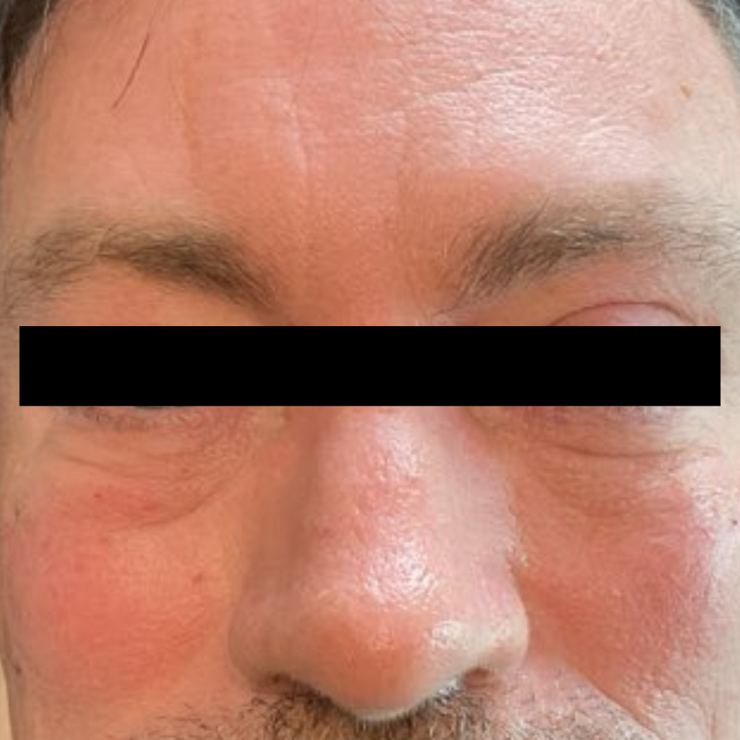 After PRP Microneedling