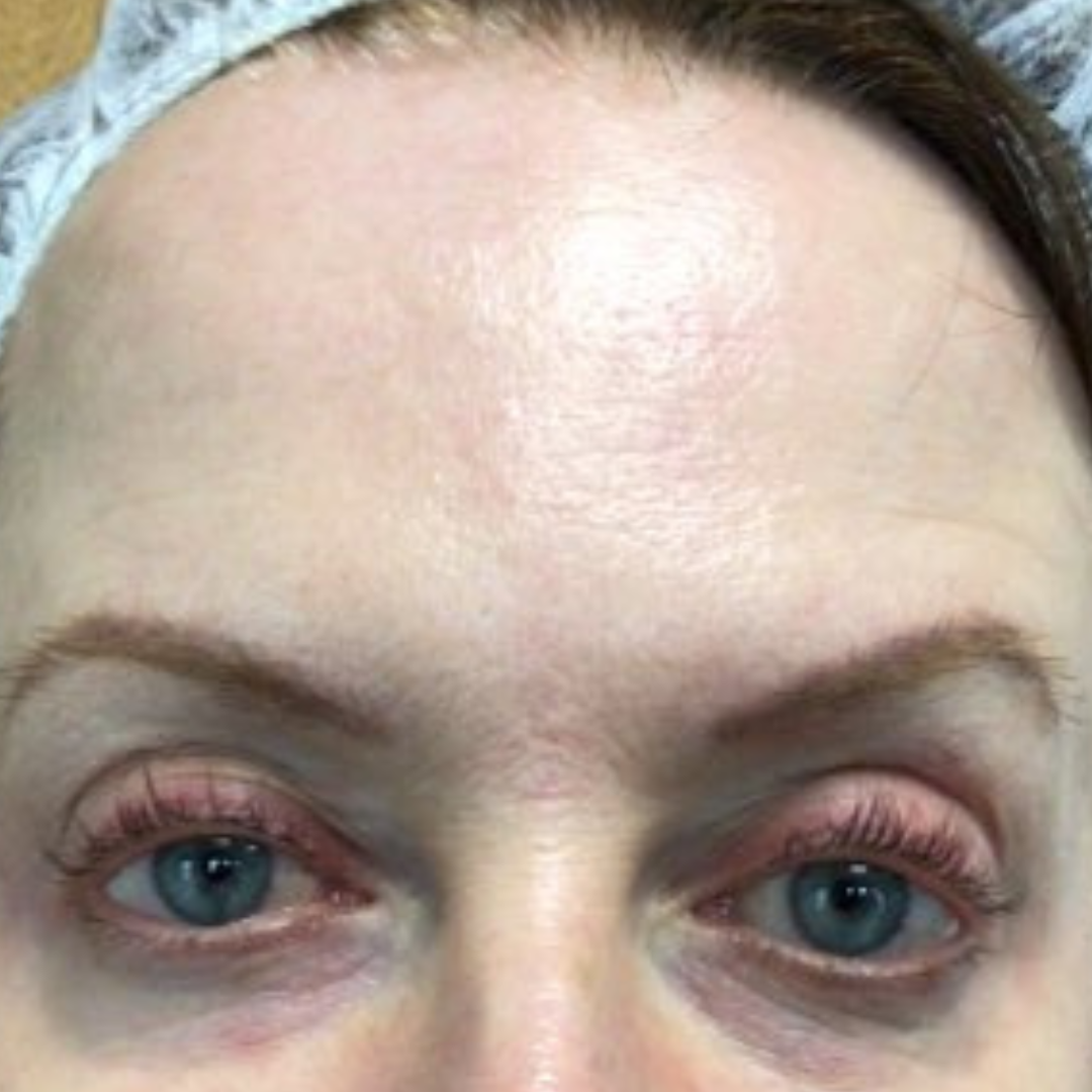 After PRP Microneedling (1)