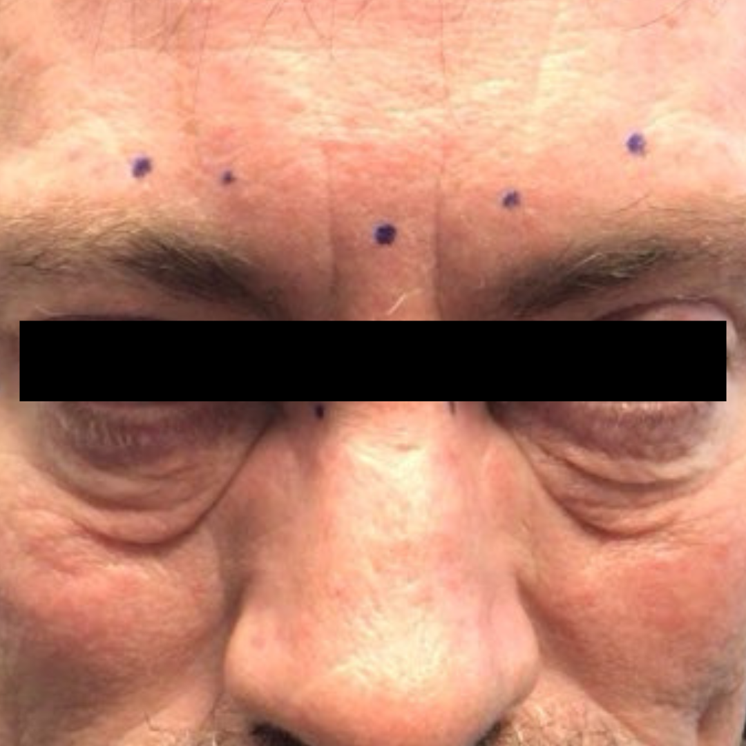 Before PRP Microneedling