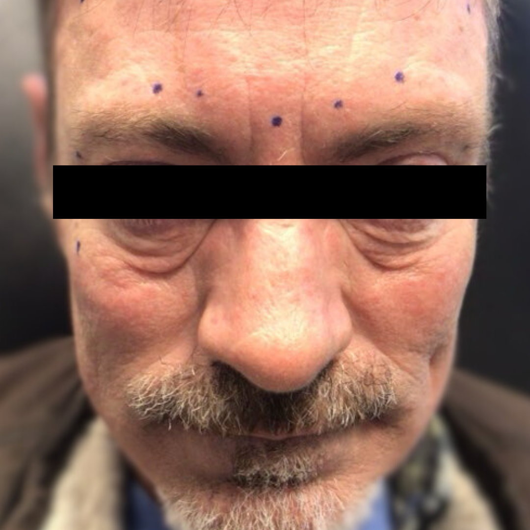 Before PRP Microneedling