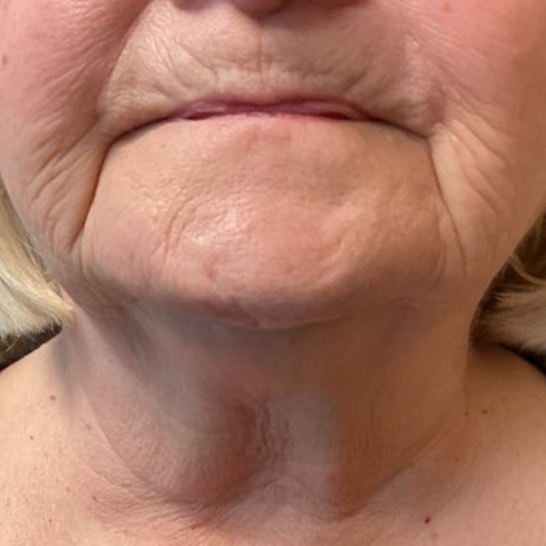 Before PRP Microneedling (1)