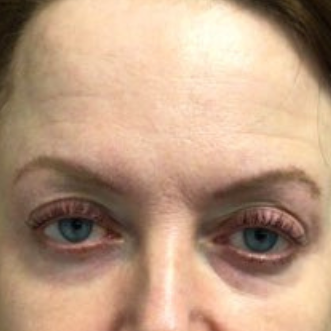 Before PRP Microneedling