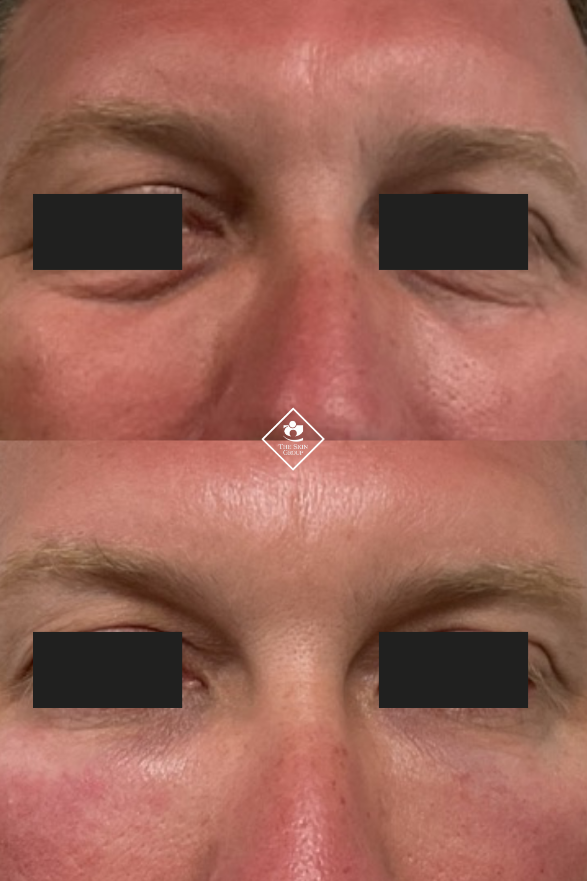 PRPEye 2