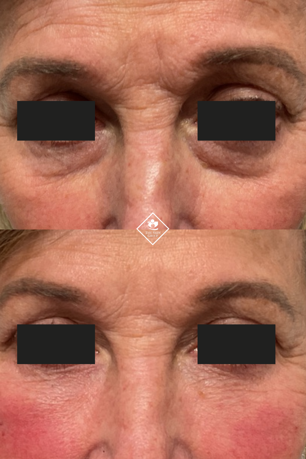 PRPEye 3