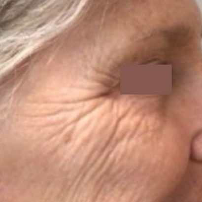 Sculptra Before